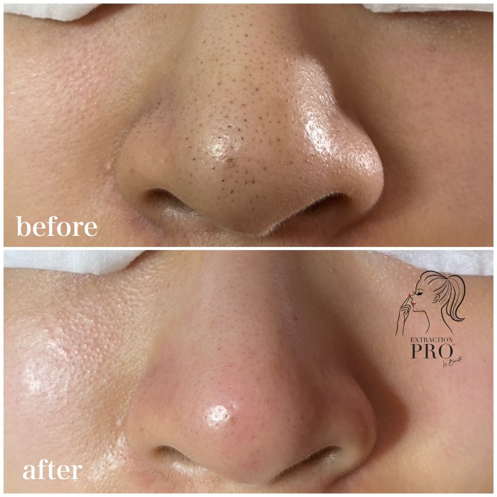 毛穴洗浄 毛穴エクストラクション